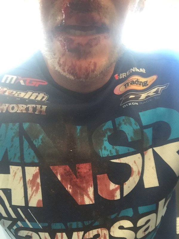 Tommy Searle bloodied nose